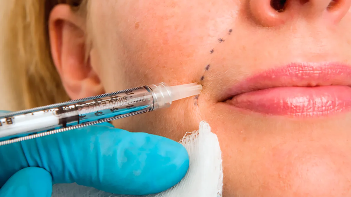 Dermal filler