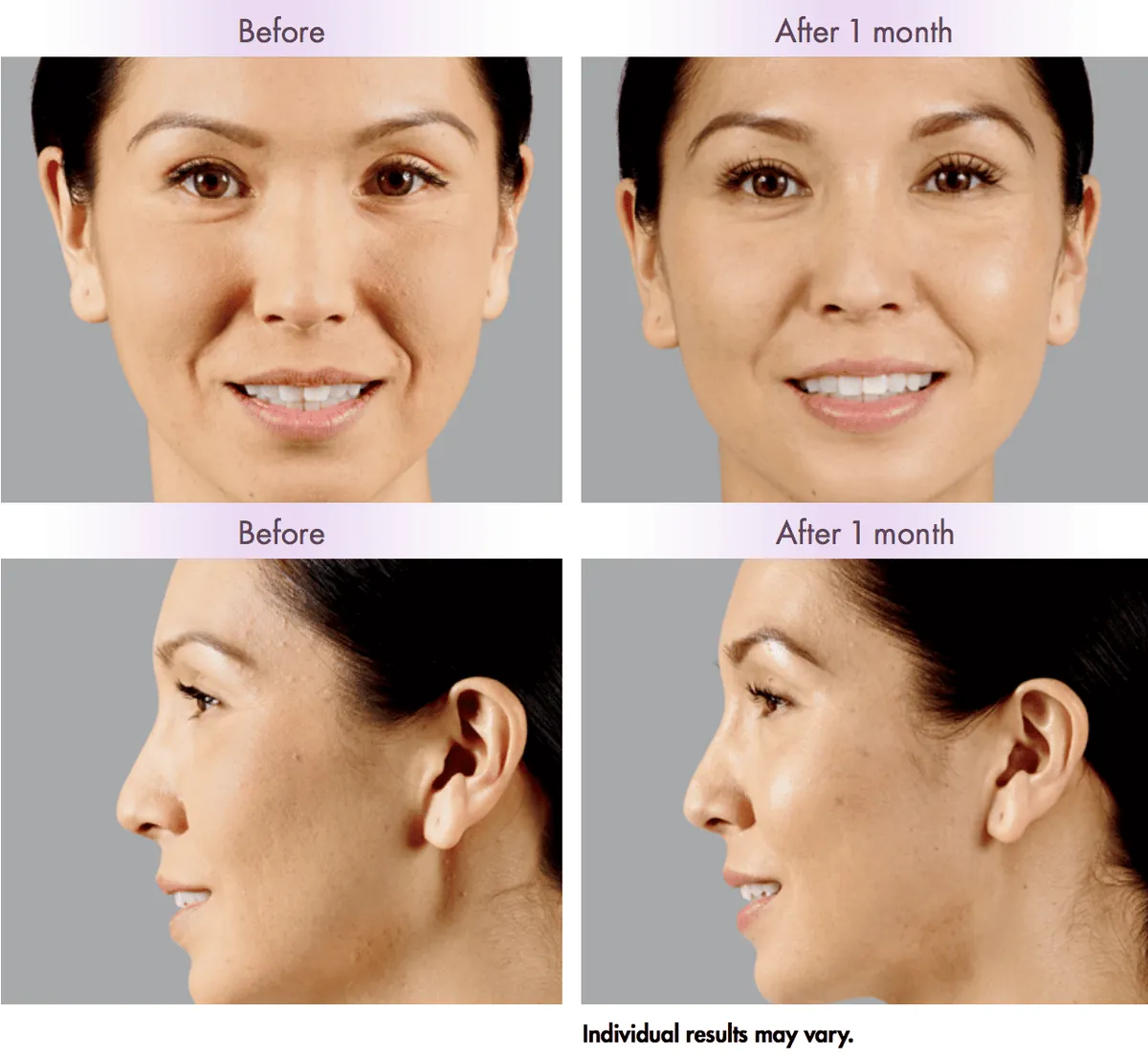 Dermal filler