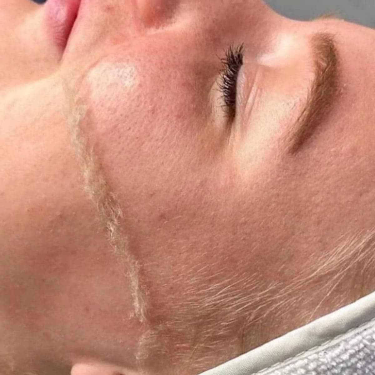 Dermaplaning