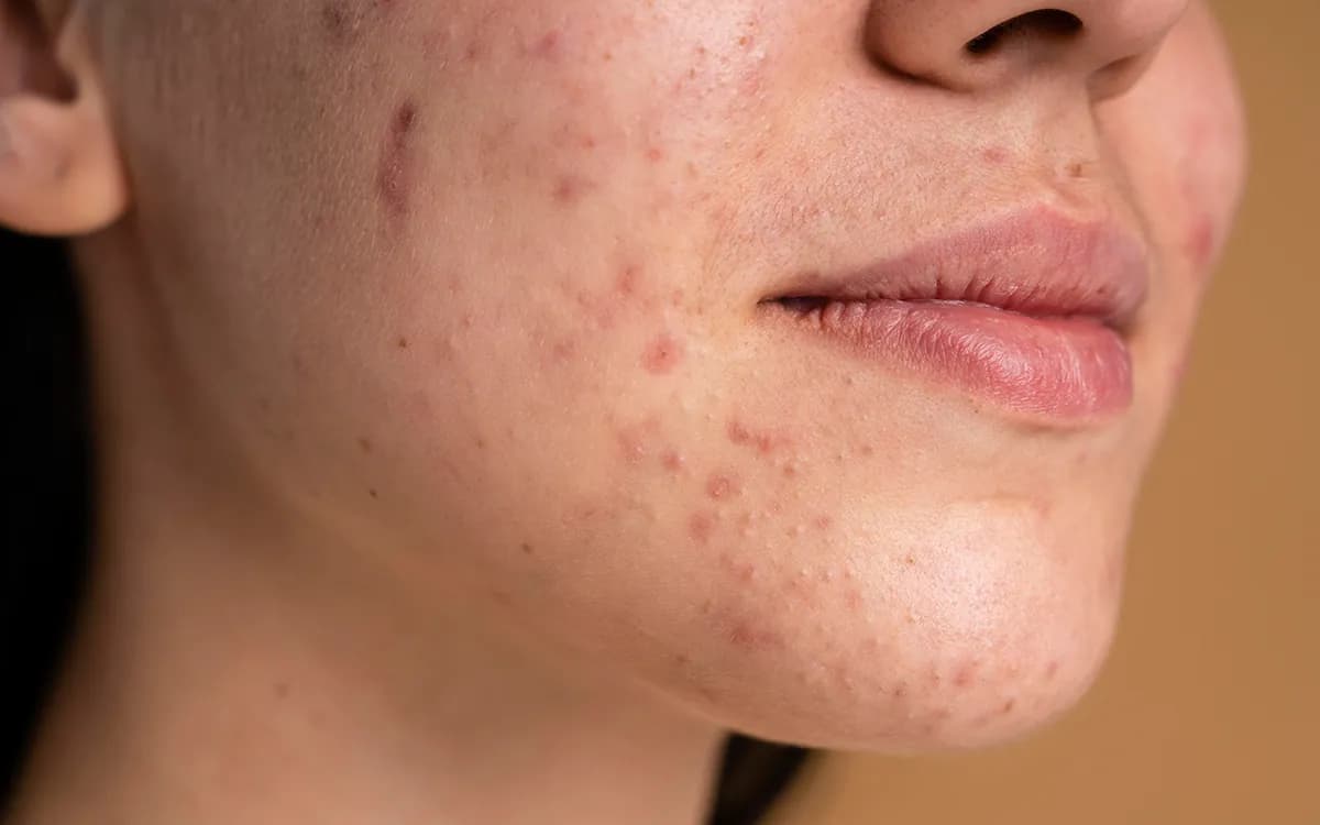 DermaV