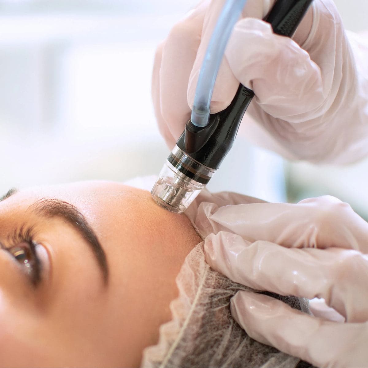Hydrodermabrasion