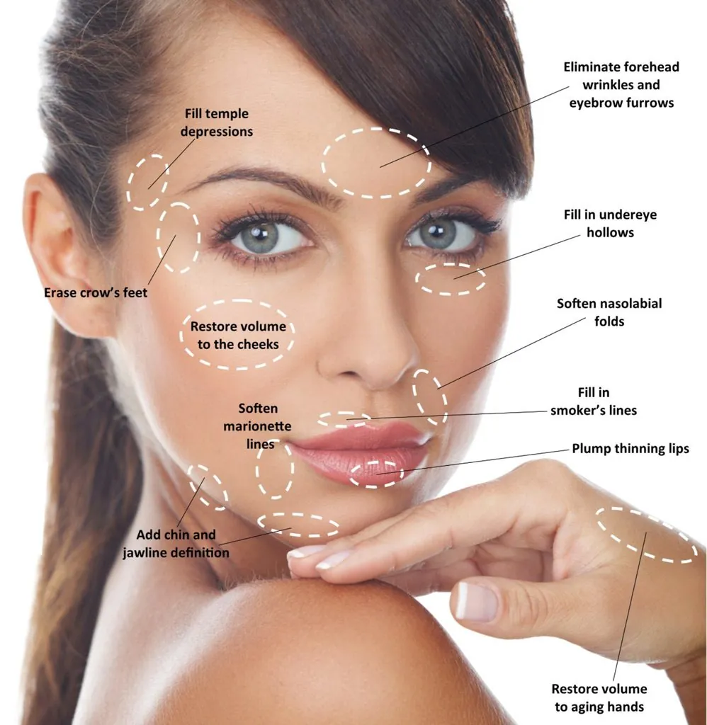 Juvederm