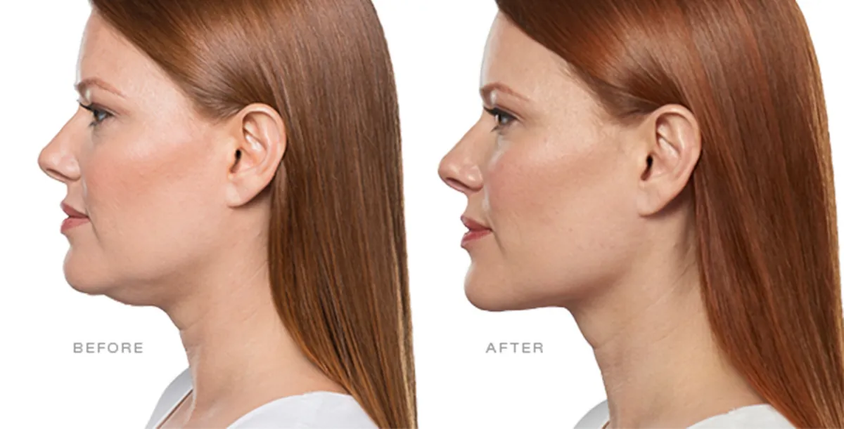 Kybella
