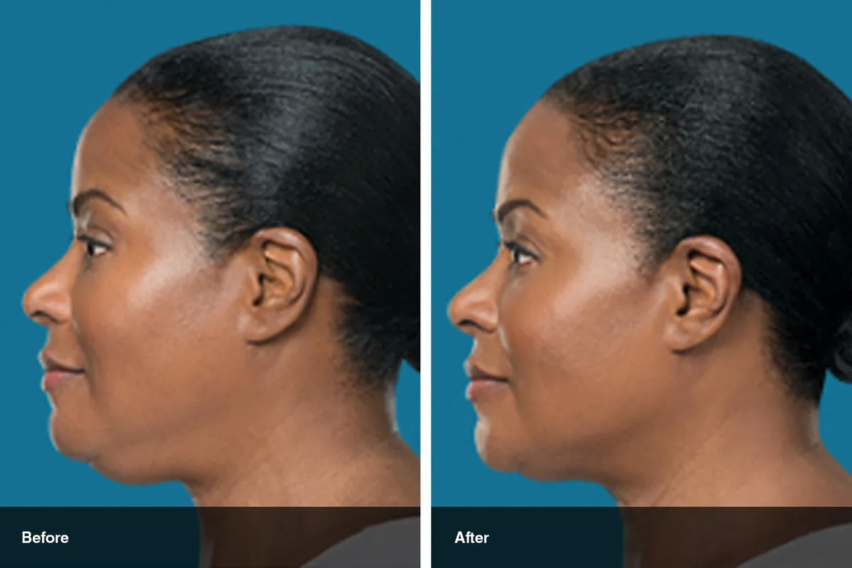 Kybella