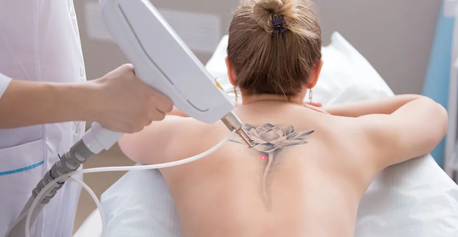 Laser tattoo removal