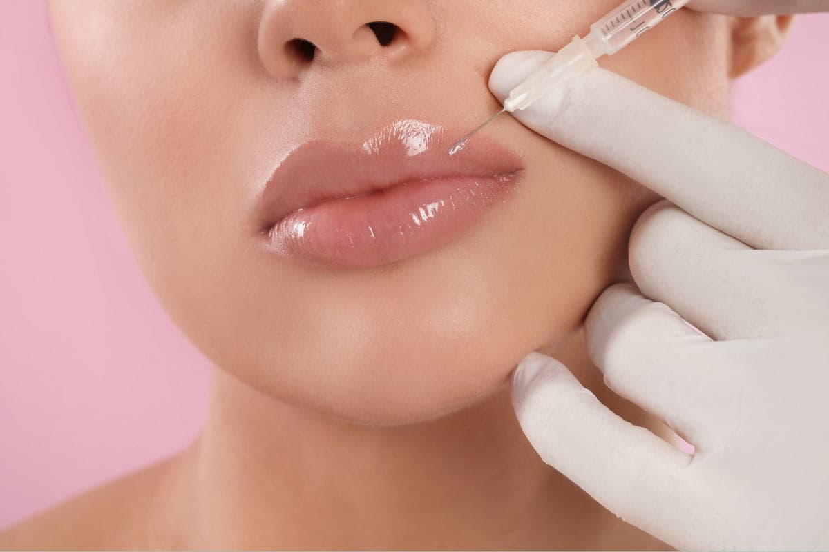 Lip filler