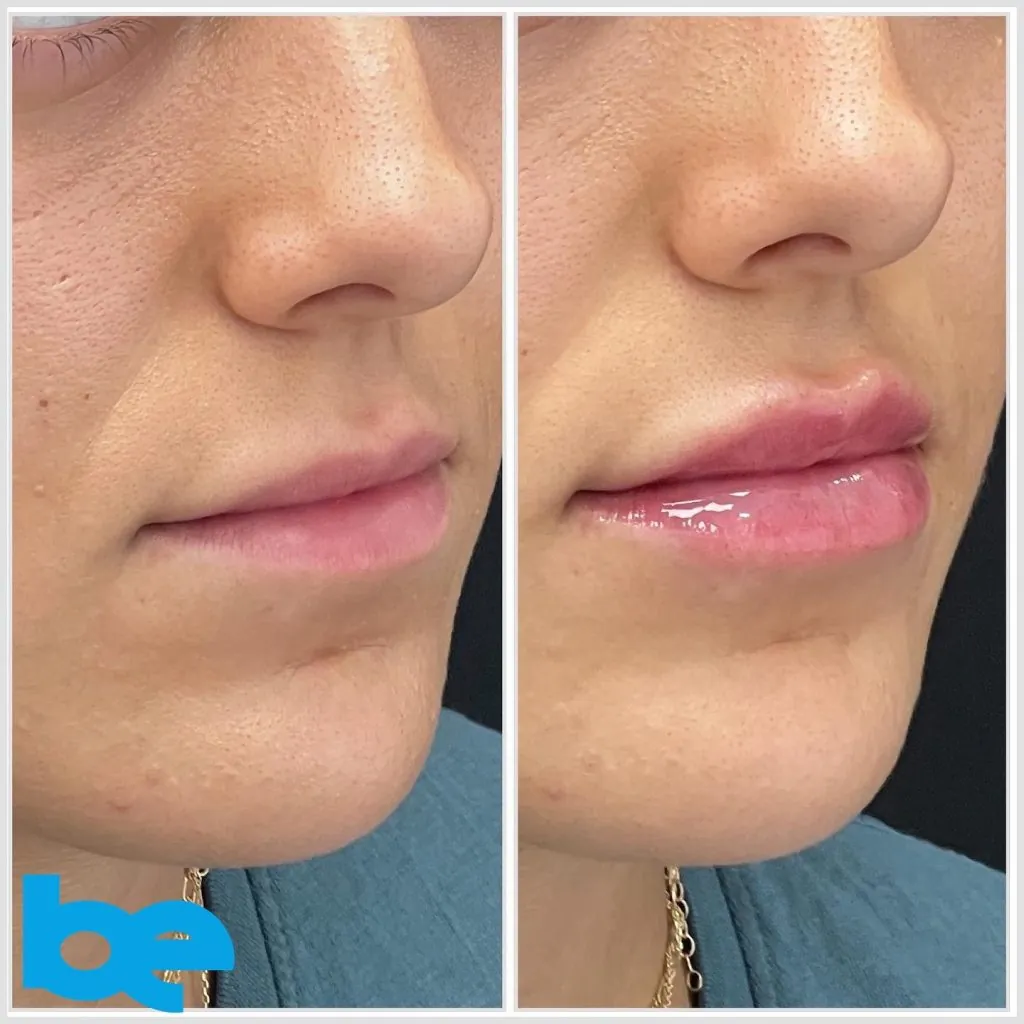 Lip filler
