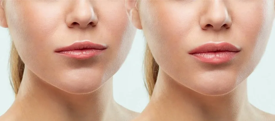 Lip filler