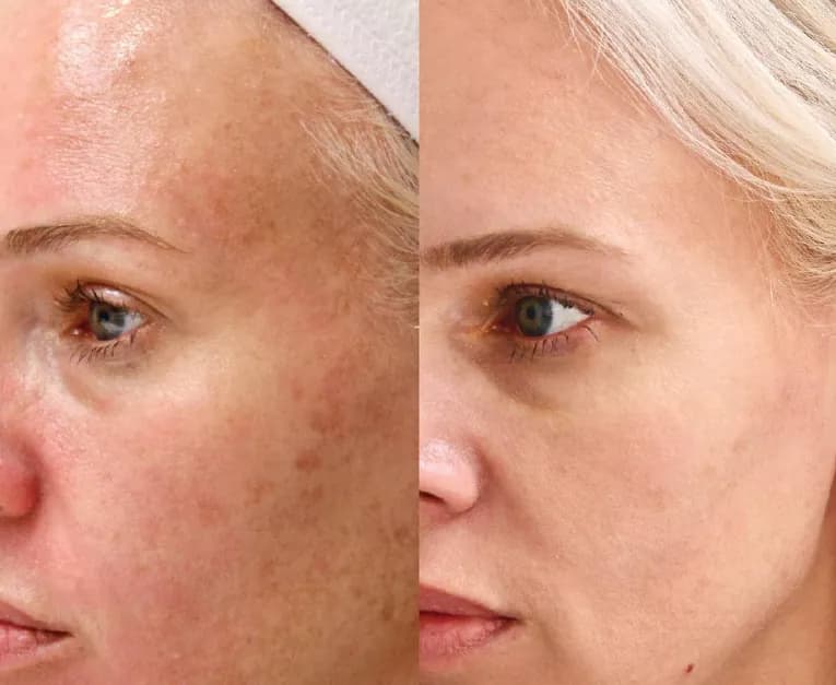 Micro-peels