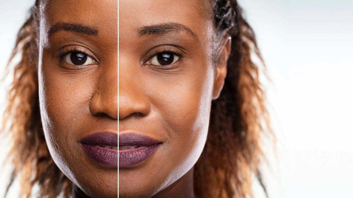 Microdermabrasion