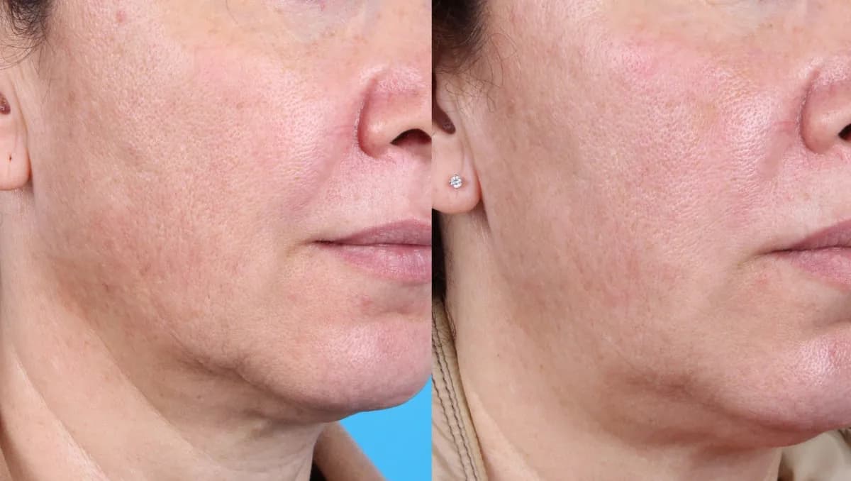 PRP injections