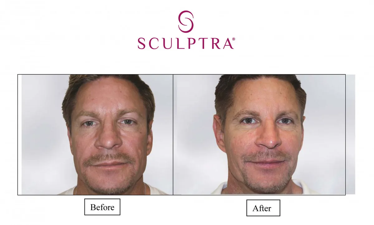 Sculptra