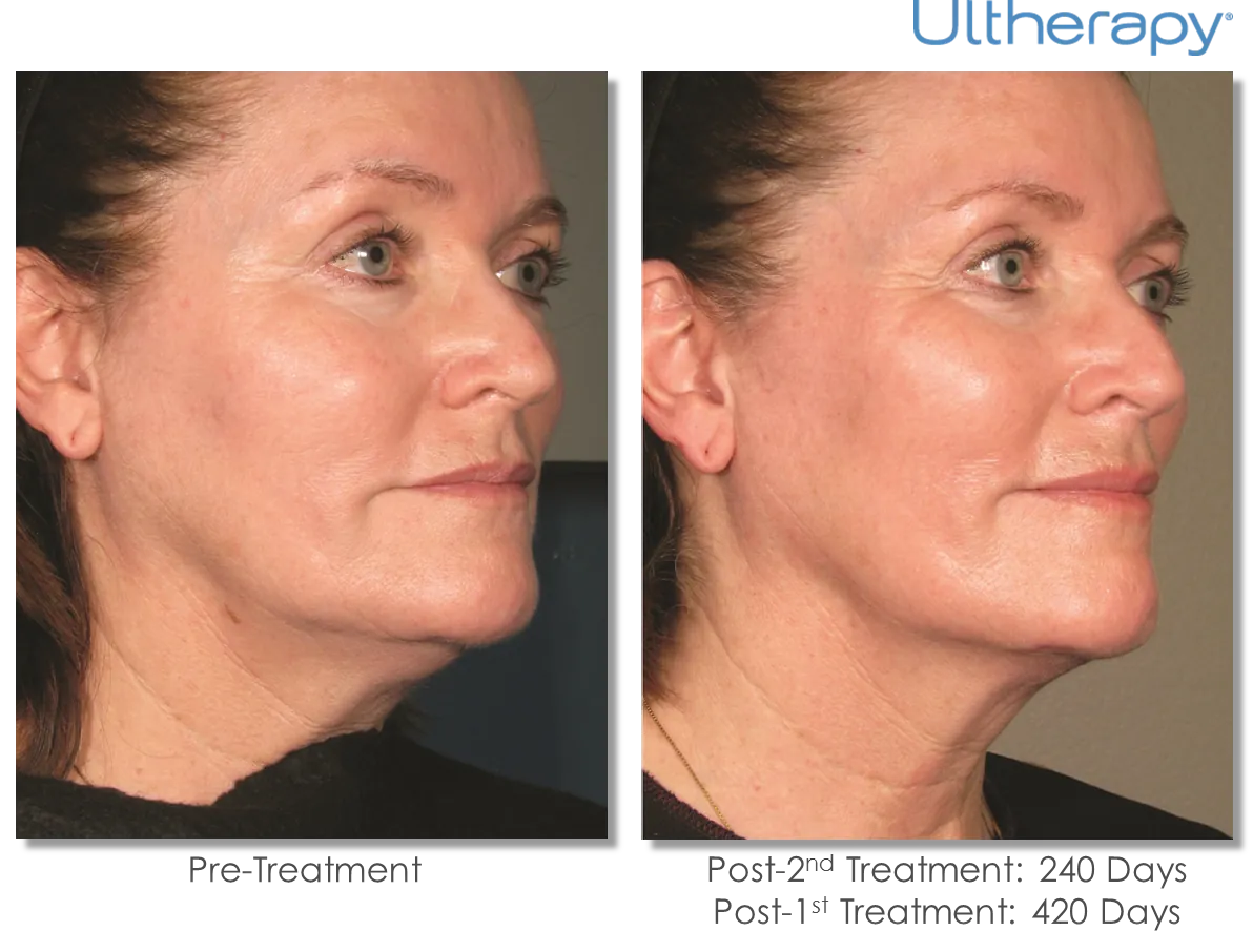 Ultherapy